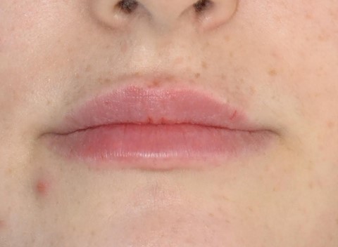 Injection acide hyaluronique pour lèvres au cabinet de médecine